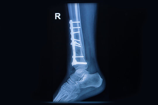 film x-ray ankle show fracture distal tibia