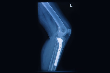 x-ray of fracture tibia, tibia bone with implant