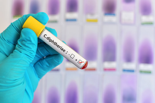 Blood sample positive with Corynebacterium diphtheria
