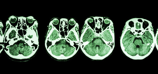 CT scan of brain and base of skull ( show structure of eye , ethmoid sinus , cerebellum , cerebrum,...
