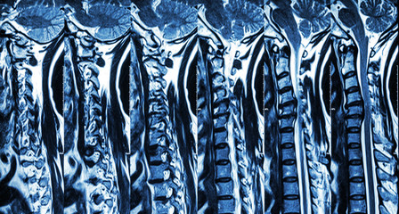 Cervical spondylosis with disc herniation ( MRI of cervical spine : show cervical spondylosis with disc herniation compress spinal cord ( Myelopathy ) )
