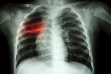 Pulmonary Tuberculosis ( Chest X-ray of child : show patchy infiltration at right middle lung )