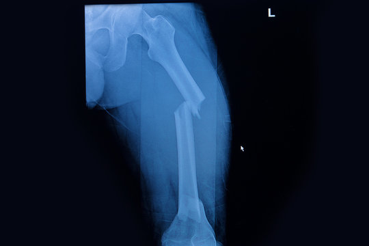 Fractured Femur, Broken leg x-rays image