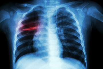 Pulmonary Tuberculosis ( Chest X-ray of child : show patchy infiltration at right middle lung )