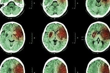 Ischemic stroke : ( CT of brain show cerebral infarction at left frontal - temporal - parietal lobe...