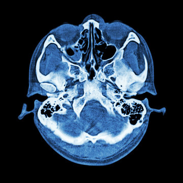 CT scan of brain and base of skull  ( Bone window )