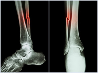 Fracture shaft of fibula bone ( leg bone ) .  X-ray of leg ( 2 position : side and front view )