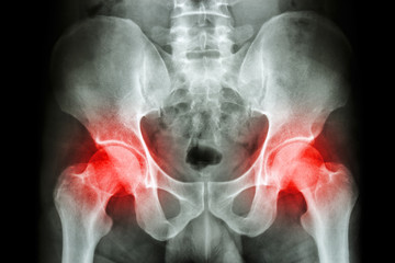 film x-ray human's pelvis and arthritis at both hip joint (Gout , Rheumatoid)