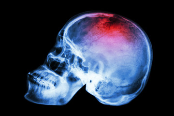 X-ray skull lateral with 