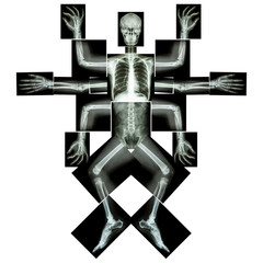 Monster have many arm. (X-ray whole body : head neck shoulder arm forearm elbow wrist hand digit...