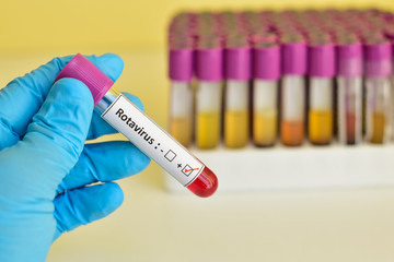 Fototapeta premium Rotavirus positive blood sample