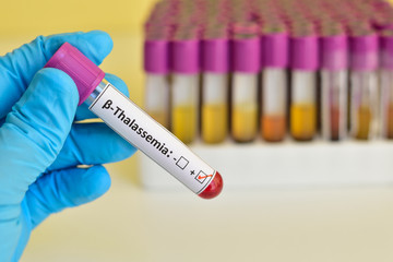 Beta-thalassemia blood sample
