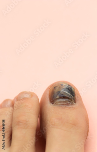 Toenail Bleeding Internally Stock Photo And Royalty Free Images On