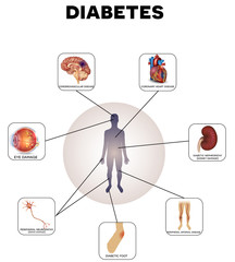 Diabetes complications - obrazy, fototapety, plakaty