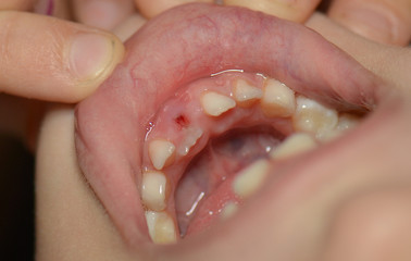 Young caucasian girl after dental extraction.