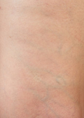 varicose veins on the skin