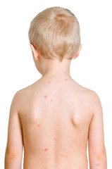 Chickenpox on the back of a white blond child