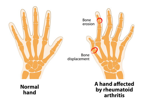 Normal hand and Rheumatoid Arthritis
