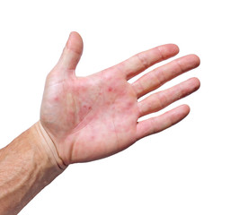 Palm patient erythema in red spots from inflammation