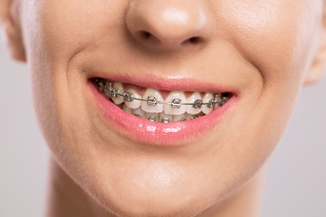 Naklejka premium Healthy smile with braces