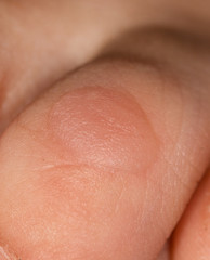 callus on the finger