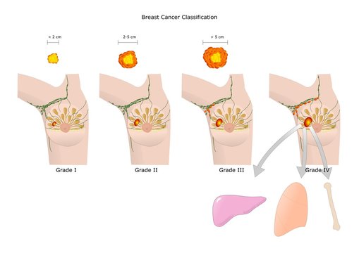 stadiazione del cancro al seno