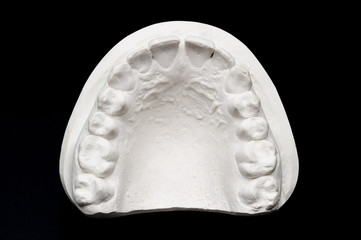 Gebiss Abformung Oben 