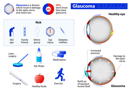 Glaucoma