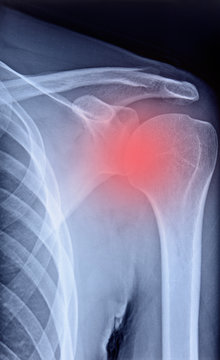 radiografia della spalla