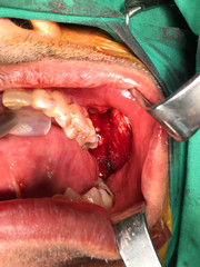 wide excision oral cavity cancer