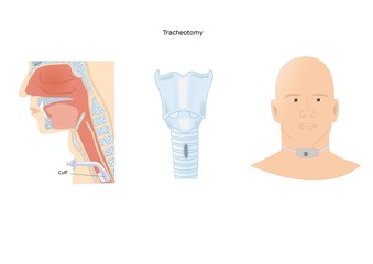 chirurgia d'emergenza: trachotomia per rendere libere le vie respiratorie