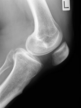 Human knee anatomy in x-ray