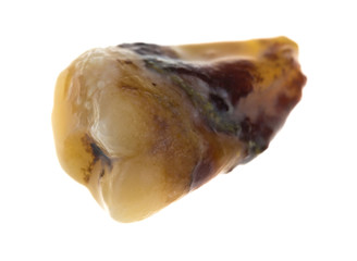 Decayed wisdom tooth