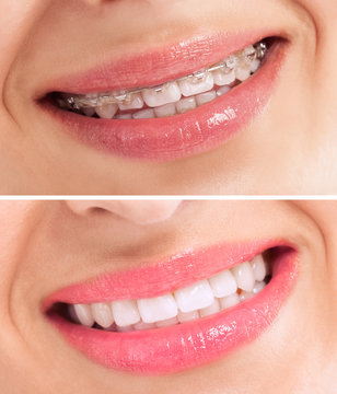 Perfect teeth before and after braces