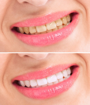 Before and after whitening treatment teeth
