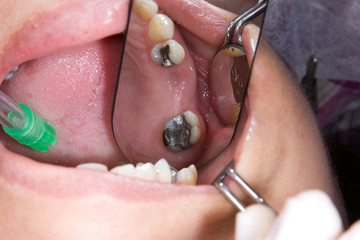 protesis parcial removible