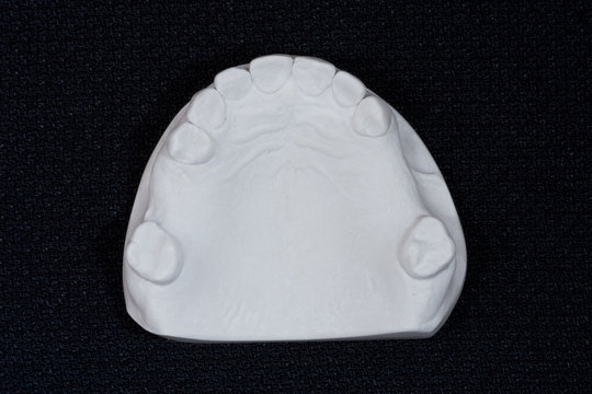 protesis parcial removible