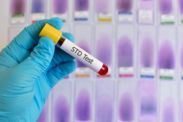 Blood sample for sexually transmitted diseases (STD) test