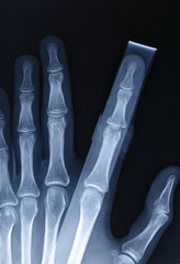 X-Ray image of human hand with stick