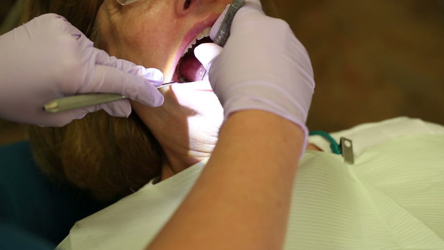 Dental Patient Receiving Teeth Cleaning from Above. shot is of a female dentist patient receiving a teeth cleaning from above. patient opens mouth and dentist uses a scraping instrument
