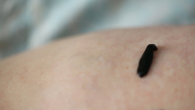 the procedure hirudotherapy, leech therapy
