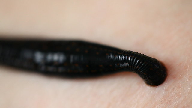 the procedure hirudotherapy, leech therapy
