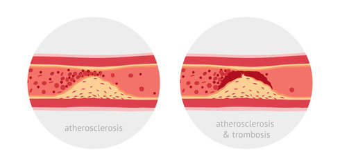 Vessels with atherosclerosis and atherotrombosis vector illustration