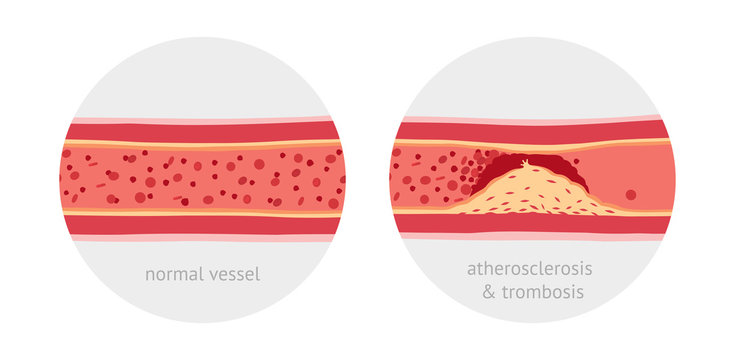 Atherotrombosis in vessels