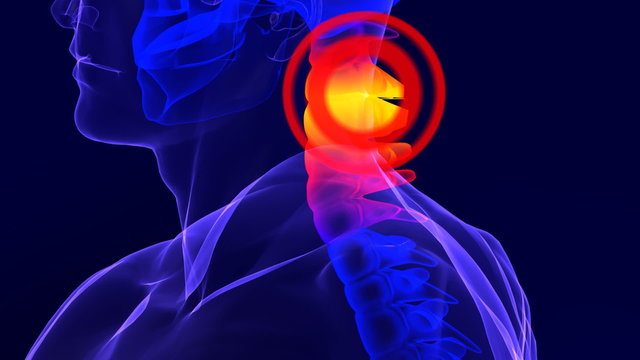 X-ray skeleton animation of neck spine pain
