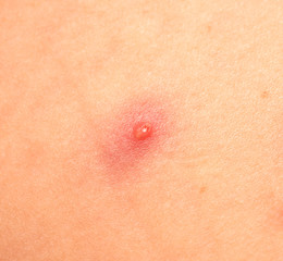 Fototapeta premium pimple