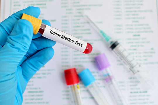 Blood sample for tumor marker test