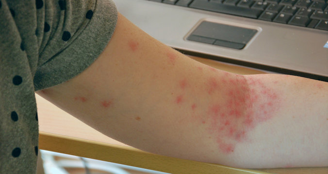 Allergic Rash Dermatitis Skin Texture Of Woman