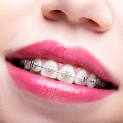 Closeup of woman open smiling mouth with  brackets