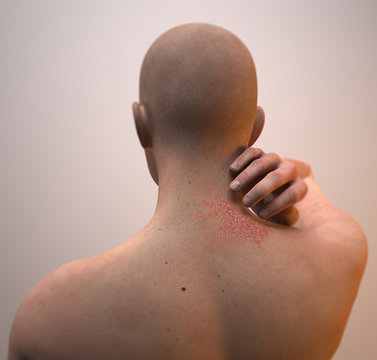 Dermatite texture, pelle bruciore e infiammazione